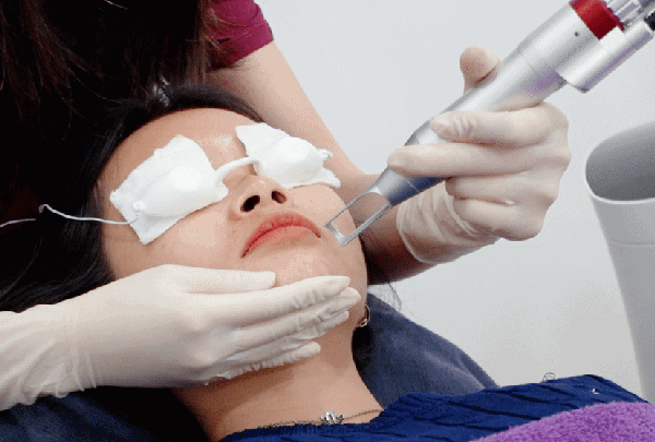 Fotona Pico Laser Treatment KL Malaysia